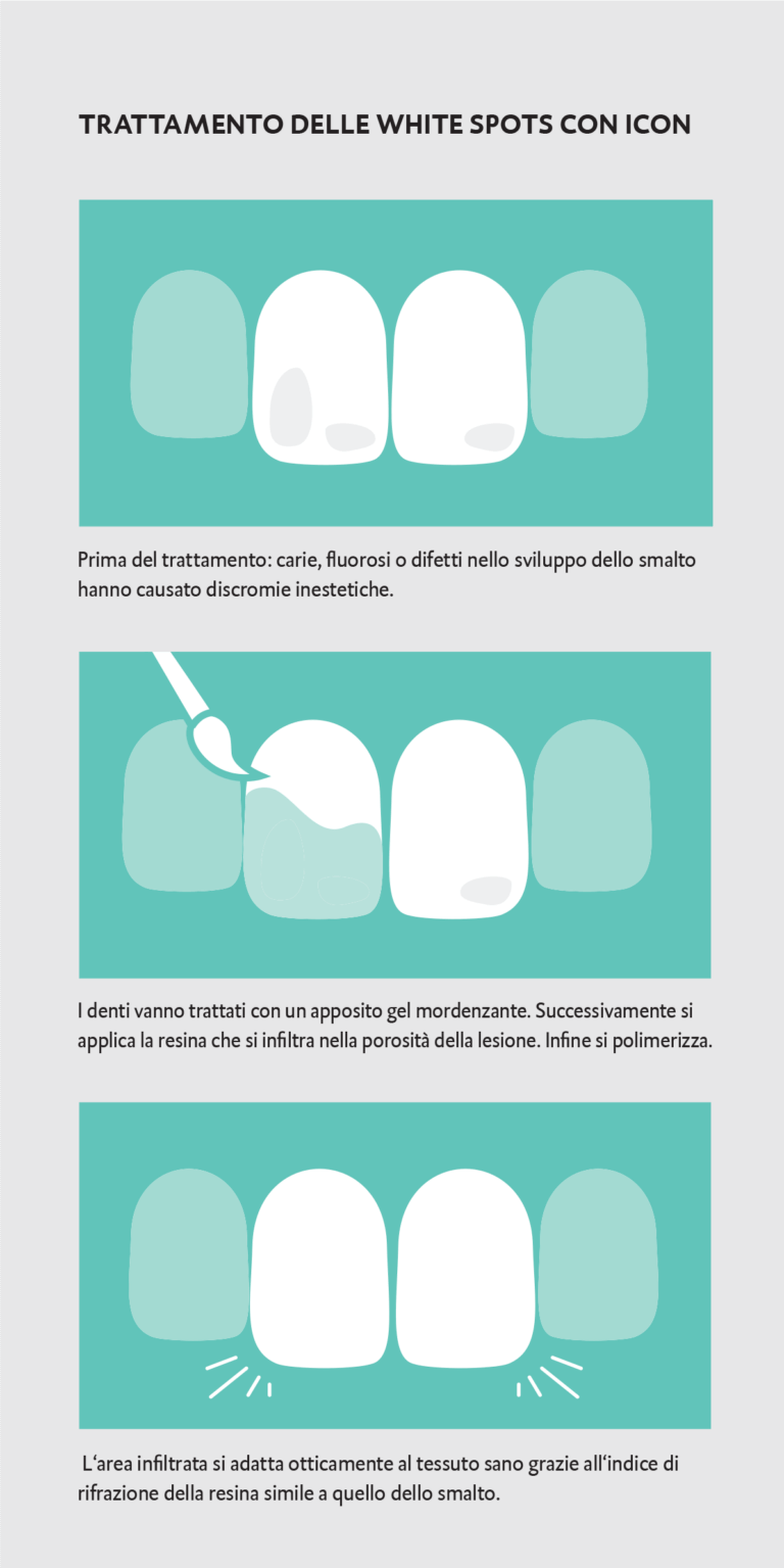 infografica sulla procedura di trattamento delle white spot con icon